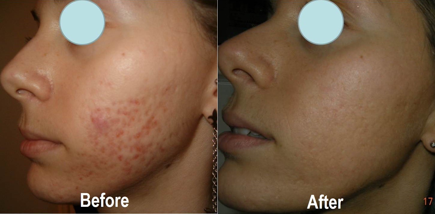 Enerpeel results with acne
